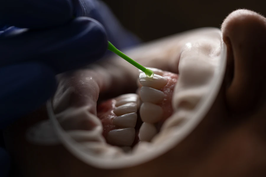 Composite material applied to the tooth surface using a cheek retractor